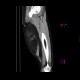 Lipoma of thigh: CT - Computed tomography